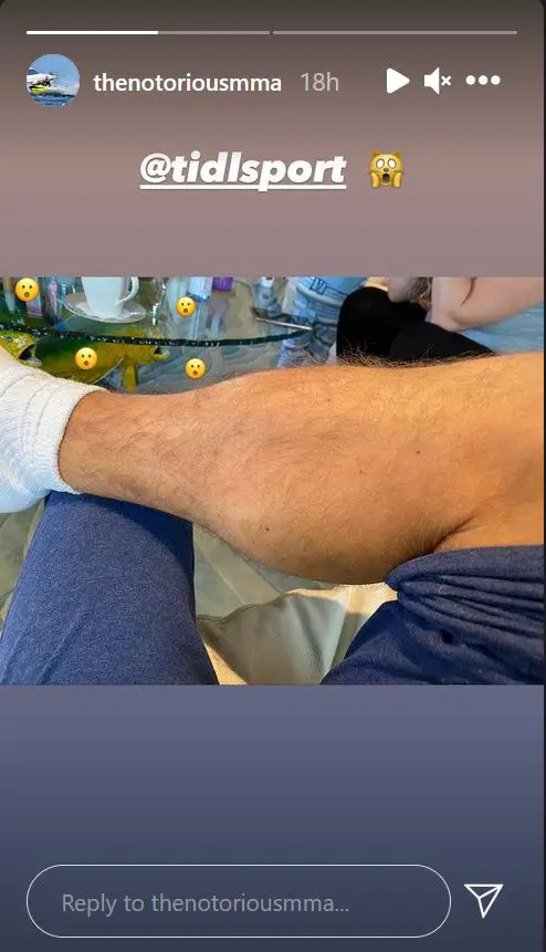 Conor McGregor posted this image of his leg on Instagram after his fight against Dustin Poirier. (Image Credits: @thenotoriousmma on Instagram)