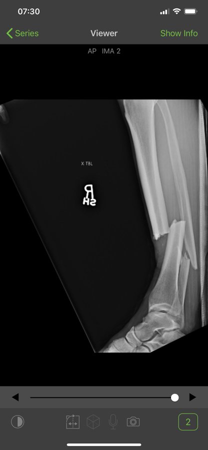 Photos Chris Weidman Shares Pre And Post Surgery X Rays Of Broken Leg